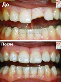 Травма зуба, перелом коронковой части зуба. Реставрация фотополимером